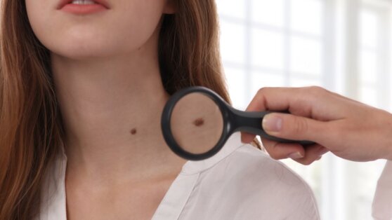Мясников рассказал об опасных изменениях родинок
