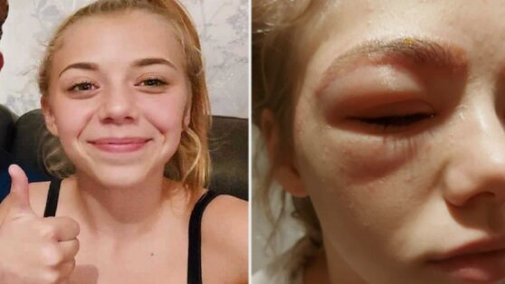 Девочка окрасила брови в салоне красоты и чуть не умерла
