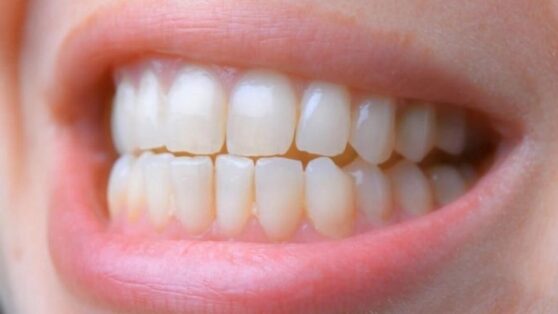 Врачи назвали 5 вредных привычек, которые угрожают правильному прикусу